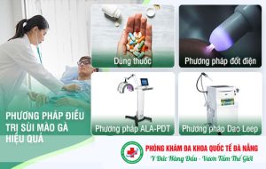 Phương pháp chữa sùi mào gà