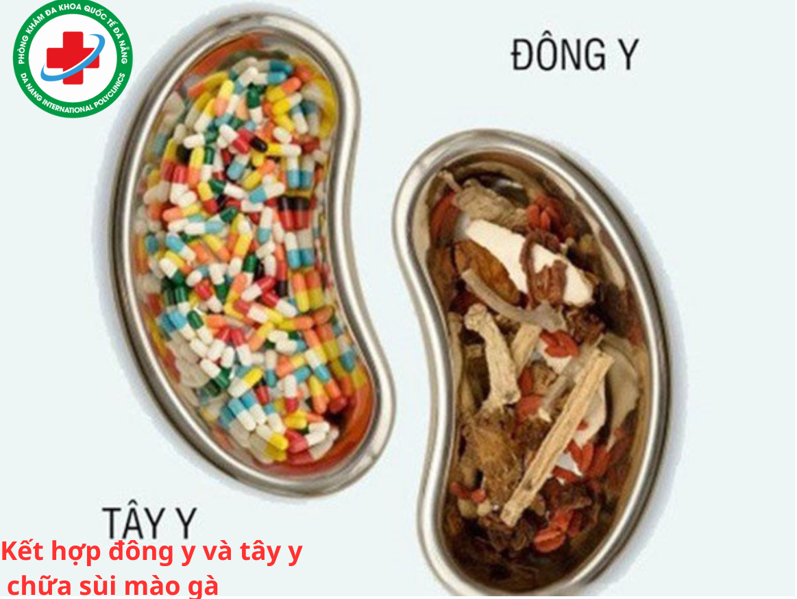 Chữa sùi mào gà bằng phương pháp đông tây y kết hợp