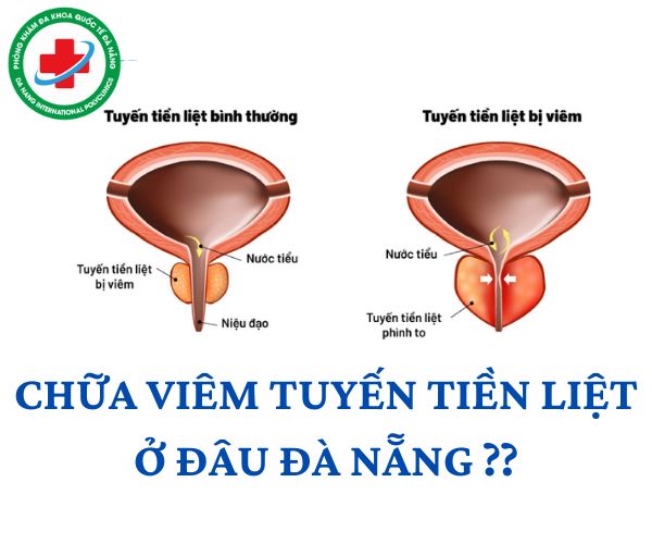 Chi phí chữa viêm tuyến tiền liệt phụ thuộc vào từng cơ sở y tế