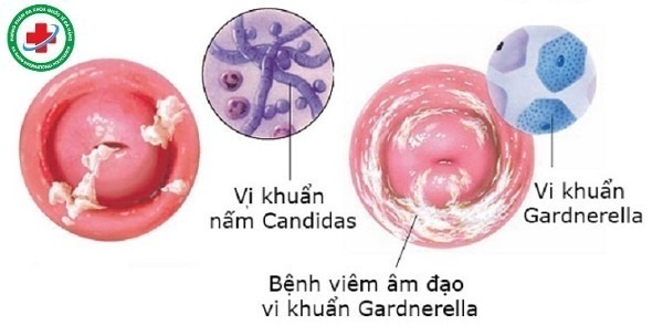 vi khuẩn gây bệnh viêm âm đạo ở nữ