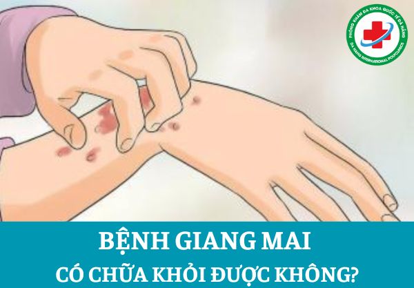 Bệnh giang mai có chữa được không?