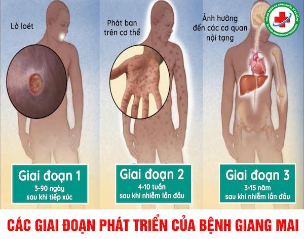 Các giai đoạn của bệnh giang mai