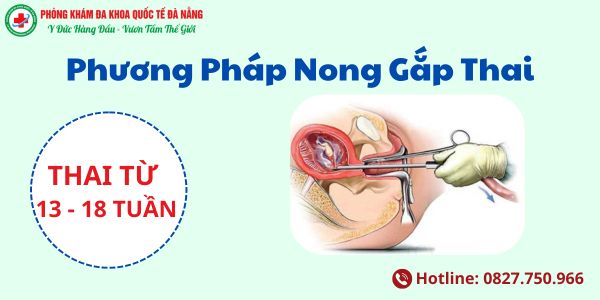 Phương pháp nong gắp thai