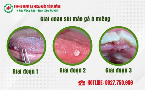 Dấu hiệu sùi mào gà ở miệng