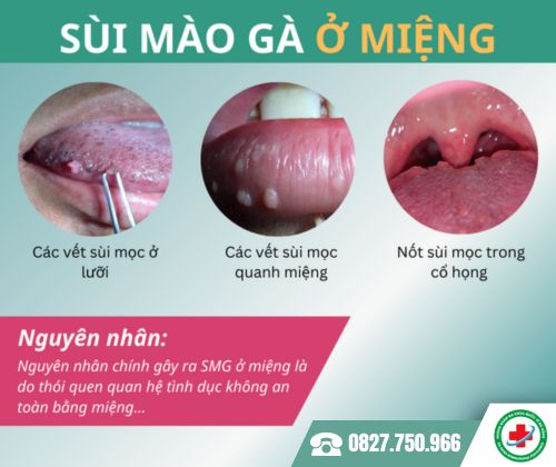 nguyên nhân sùi mào gà ở miệng