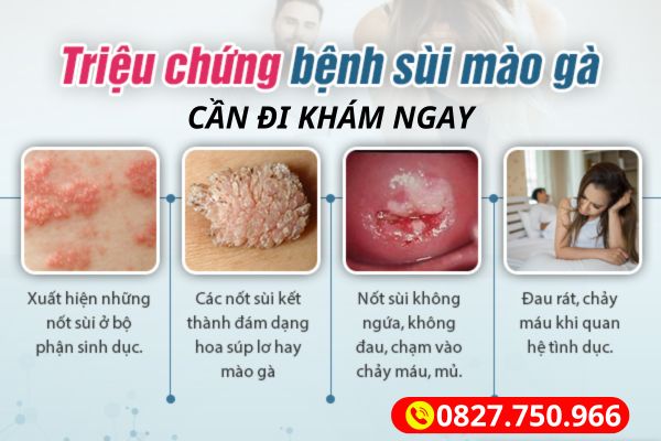 triệu chứng sùi mào gà