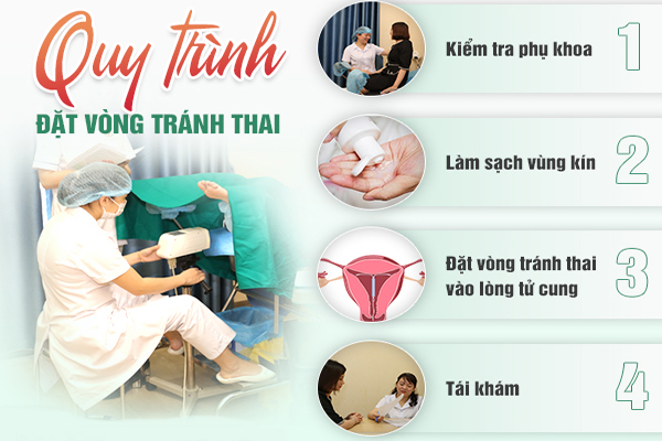 Quy trình đặt vòng tránh thai