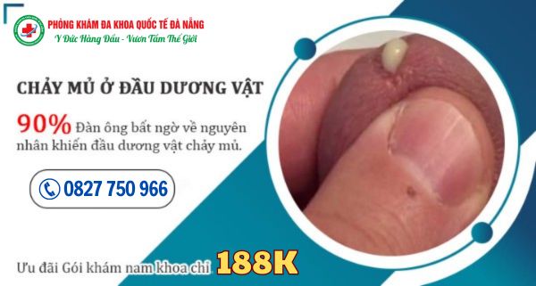 Dương vật chảy mủ là dấu hiệu cảnh báo bệnh lý nam khoa nào?