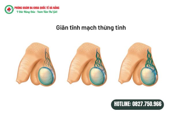 Giãn tĩnh mạch thừng tinh